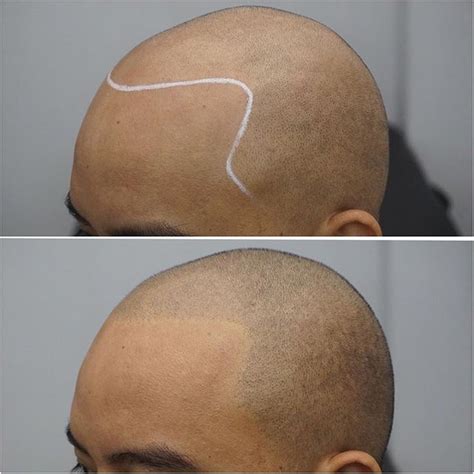 scalp micropigmentation manila philippines|Scalp Micropigmentation in Metro Manila, Philippines • Check .